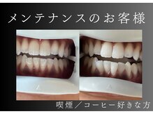エランホワイトニング 一社店/症例写真