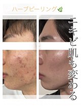 バーグトータルビューティー(bague total beauty)/ニキビにお悩みの方におすすめ