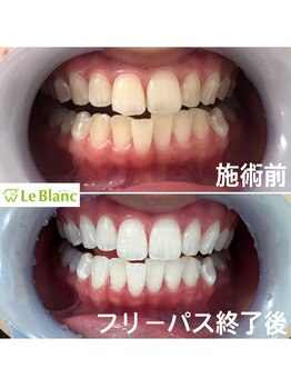 ルブラン 奈良店(Le Blanc)/気になるホワイトスポット