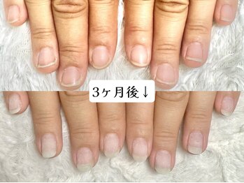 グラシナ なんば店/深爪/自爪育成/フィルイン