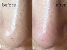 ジェリー(JERRY)/小さな黒ずみ