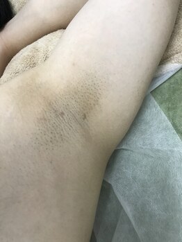 ナノハナ/鹿沼市本格全身脱毛ナノハナ