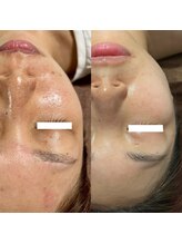 ワイサロン(Y salon)/陶肌トリートメント/4回目