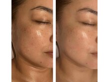 アドビューティ(Add Beauty)/≪小顔リフト／シワたるみ改善≫