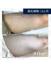 メンズクリア 武蔵小杉店/【メンズクリア】お客様の施術例