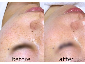 フラックス 京都(FLUX)/【エンビロン】くすみケアコース