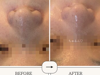 ハイフン(HIFUN)/毛穴洗浄×美白