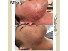 シンデレラ メンズ(Cinderella)/ニキビケア