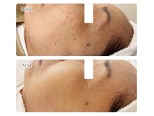 オービーエム 博多阪急店(O.B.M)/【60代シミケア症例】