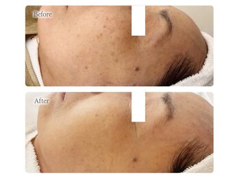 オービーエム 博多阪急店(O.B.M)/【60代シミケア症例】