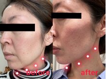 ビーエフジー(B F G)/フェースラインたるみケア