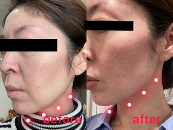 ビーエフジー(B F G)/フェースラインたるみケア