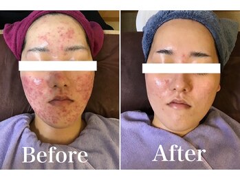 ビソウ(Biso)/光フェイシャル