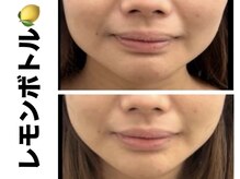 ブレア(Blair)/脂肪分解/レモンボトル