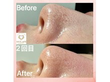 ミラン(MiLaN)の雰囲気（毛穴/角質/黒住/ニキビにお悩みの方◎ハイドラヴィーナス☆）