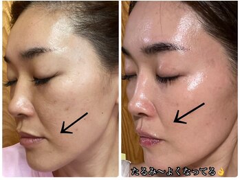 シャイン(shine)/最先端のHARI美容