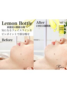 小顔になりたい