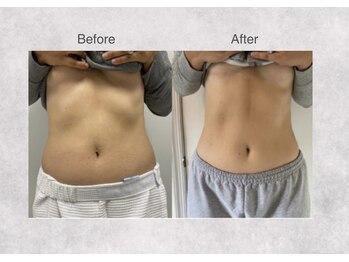 ミセル 尾道店(MYTHEL)/before after お腹