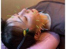 リ ムーヴ鍼灸整体院 大宮駅前院/☆美容鍼