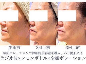 ディアスマイル(Dear.smile)/レモンボトル