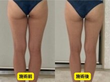 ミル(miru)の雰囲気（全身デトックス120分#インディバ#堀江#難波#美脚#痩身）