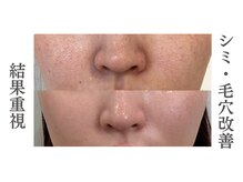 リアム(LiAm)の雰囲気（脂肪分解/レモンボトル/レッドショット/毛穴ケア/）