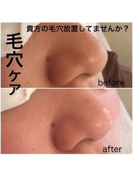 カウピリ(kaupili)/毛穴エクストラクションプロ