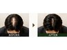 ★待望のスカルプ棘ケア★抜け毛・髪のボリュームに◎頭皮環境改善ヘッドスパ