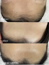 プアマヌ(PUA MANU)/顔ワックス+美肌光脱毛