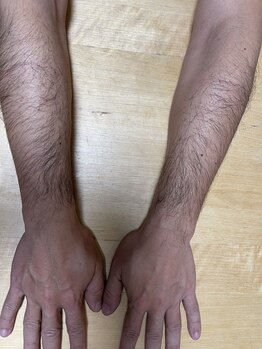 プライマル(PRIMAL)/男性腕脱毛の施術事例