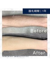 メンズクリア 武蔵小杉店/【メンズクリア】お客様の施術例