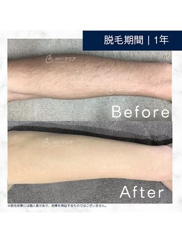 メンズクリア 武蔵小杉店/【メンズクリア】お客様の施術例