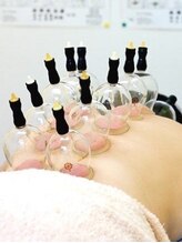 アイワ鍼灸整骨院/カッピング