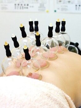 アイワ鍼灸整骨院/カッピング