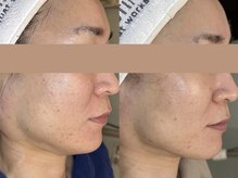 ロイ 初生店(LOI)/寝ているだけで小顔に！