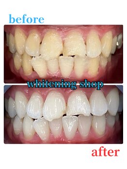 ホワイトニングショップ 豊田店(WHITENING SHOP)/ホワイトニングの効果