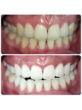 ホワイトニングセンター 広島福山駅前店/福山市・尾道市ホワイトニング