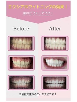 エクシアホワイトニング 静岡駅前店/ビフォーアフター
