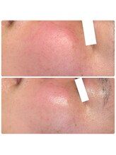 ディオーネ 春日井勝川店(Dione)/ヒト幹細胞毛穴洗浄