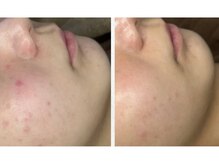 ルアーナ(Luana)/ハーブピーリング