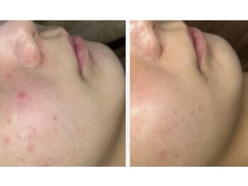 ルアーナ(Luana)/ハーブピーリング