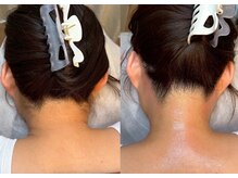 エルピス(ELPIS)/うなじミックス脱毛