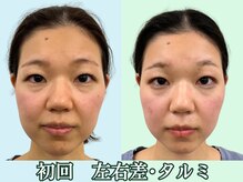 ナチュラルパーフェクトフェイス 新宿/初回/渋谷区小顔矯正