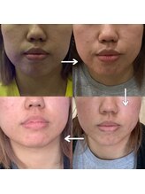 トータルヘルスビューティーカズ(TotalHealthBeauty KAZU)/【肌質改善】光の森/光美容