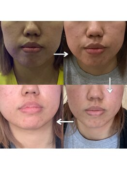 トータルヘルスビューティーカズ(TotalHealthBeauty KAZU)/【肌質改善】光の森/光美容