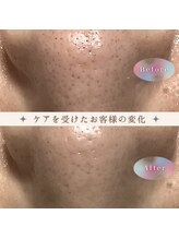 ピュリフィケーション(Purification)/気になる毛穴の黒ずみ・毛穴洗浄