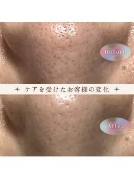 ピュリフィケーション(Purification)/気になる毛穴の黒ずみ・毛穴洗浄