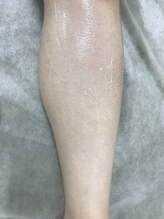 ナノハナ/鹿沼市本格全身脱毛ナノハナ