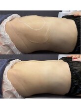 ナラビューティー(NARA BEAUTY)/お腹1回効果