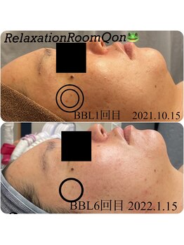 クオン(Qon)/BBL光フェイシャル